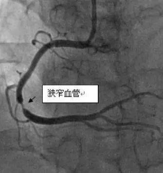 你所不知道的给心脏血管"拍照"那点事_造影