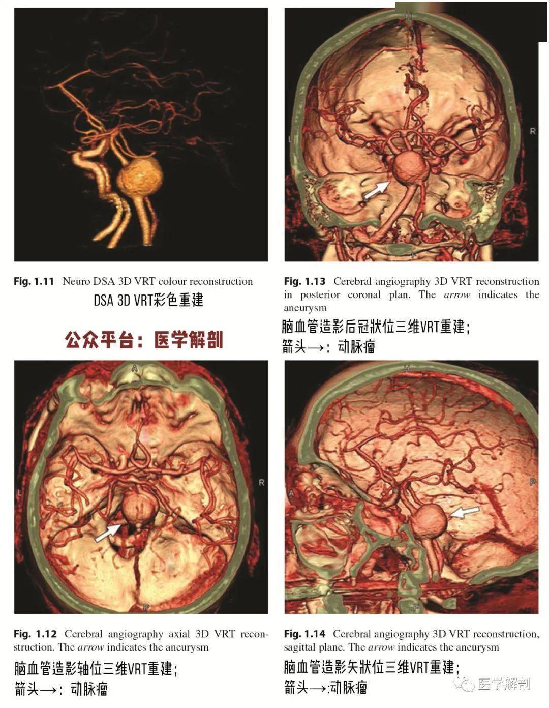 脑cta图谱 | 基底动脉瘤