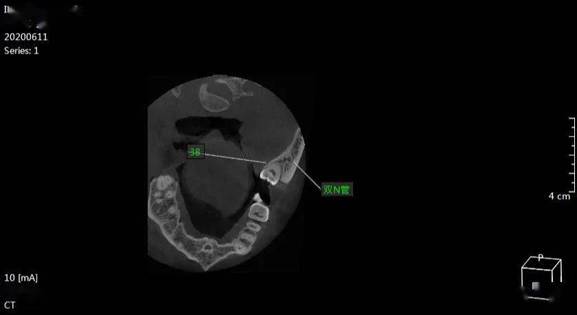 ct示:38 48近中低位阻生 牙冠均偏舌侧 牙根紧邻下颌神经管上壁 38
