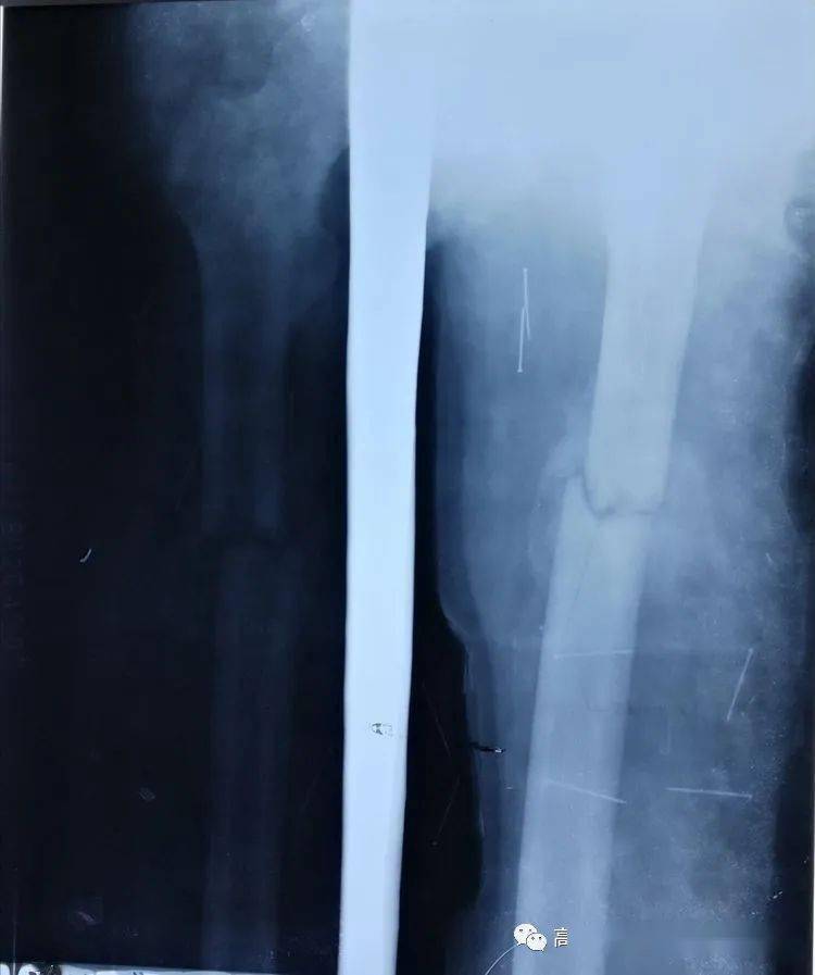 伤后60天的x线片,骨折端有大量骨痂形成,伤后61天去除骨牵引.