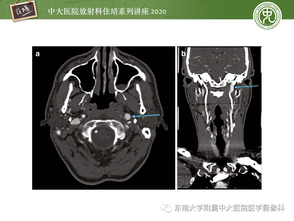 颈动脉夹层及夹层动脉瘤的影像诊断及评估