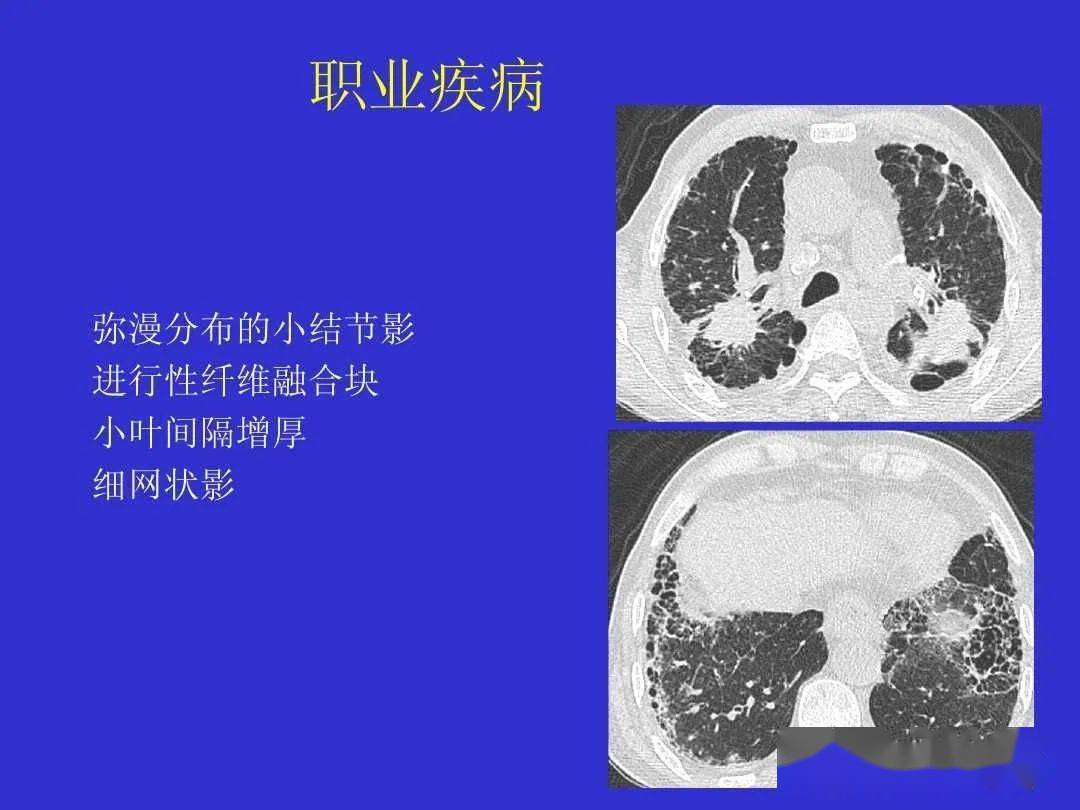 日常工作中间质性肺疾病的影像诊断思路