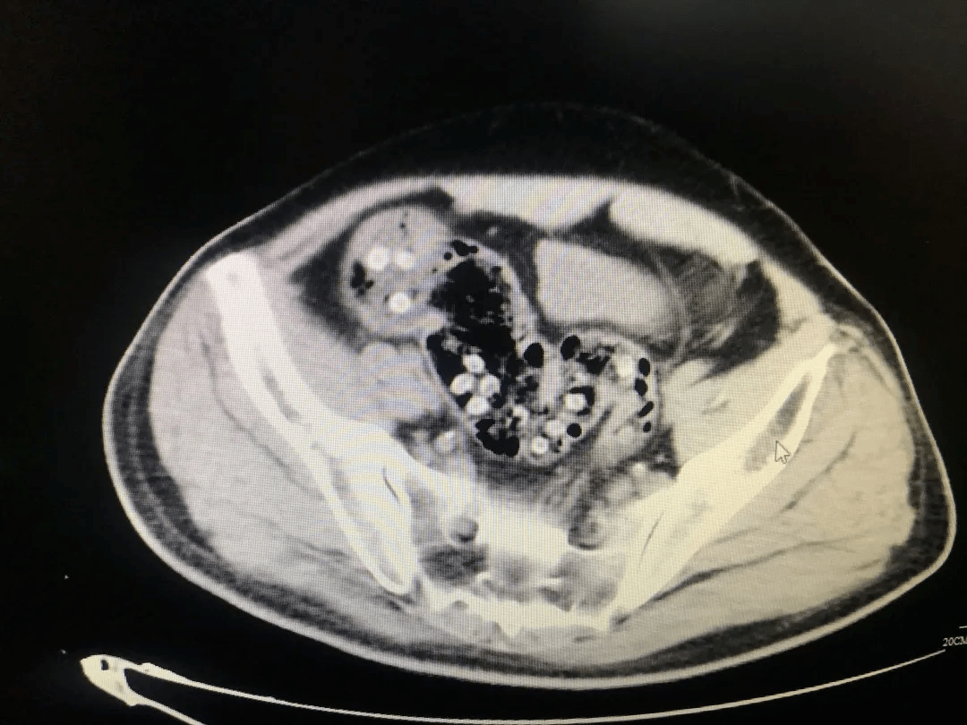 浙江义乌市中心医院急诊科 医生 患者入院时腹部膨隆明显,上腹疼痛