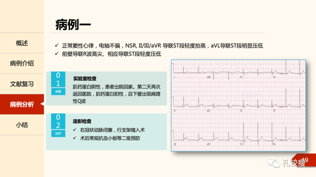 如何巧用avl导联诊断下壁心肌梗死