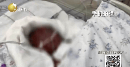 田伟|请继续加油！烫伤男童小欣宇醒了！孩子