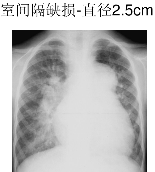 x线中的心影增大,你真的会看吗?