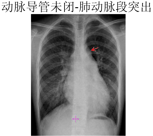 x线中的心影增大你真的会看吗