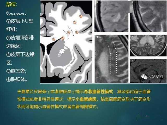 脱髓鞘疾病腔隙性脑梗死与血管周围间隙的鉴别诊断