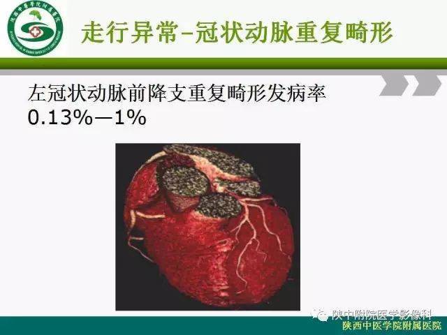 冠脉的正常解剖与变异