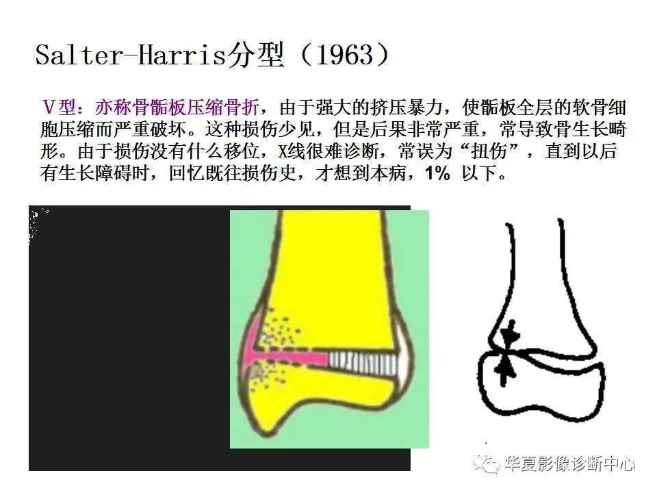 【影像基础】儿童骨骺损伤影像学分型