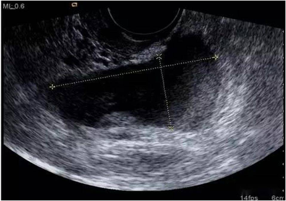超声典型病例子宫穿孔