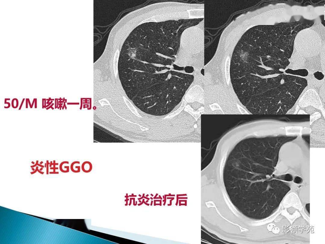 肺泡癌影像诊断与鉴别诊断