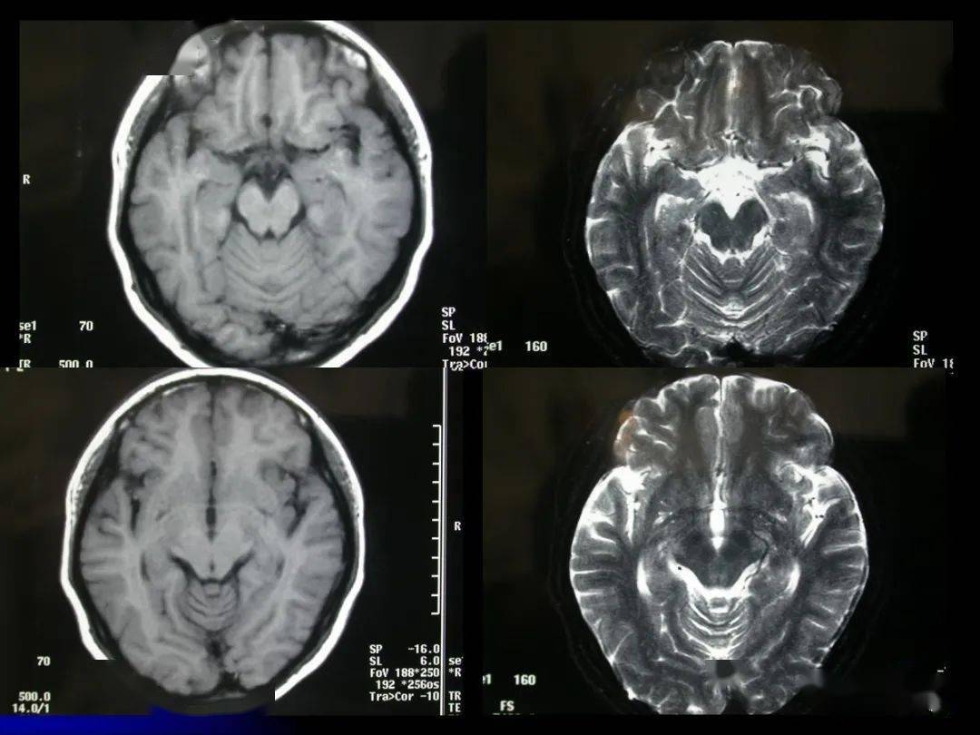 脑干区常见病变影像表现