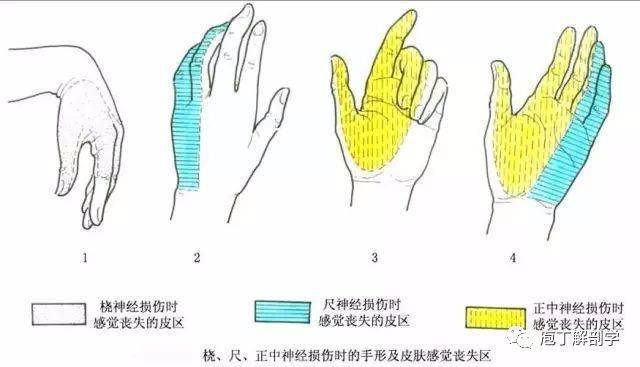 尺神经单纯性损伤可出现"爪形手".