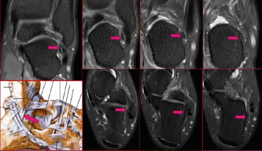 踝关节mri解剖及7种常见损伤类型