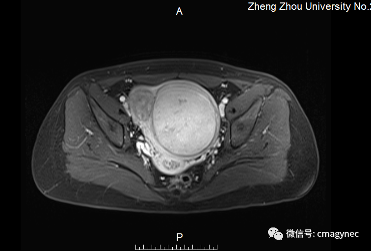 "满妇经纶"病例展示-经脐单孔腹腔镜子宫肌瘤剔除术一例(第三期)