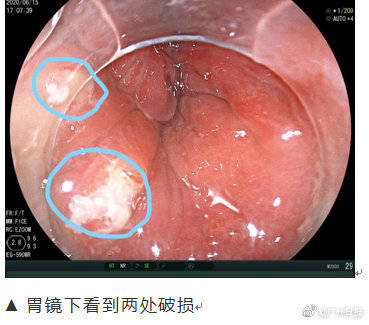 金属|如鲠在喉！深圳一男子食堂吃饭吞下2.5厘米金属针
