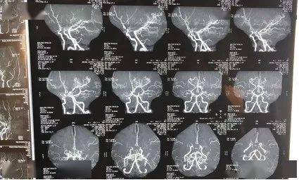 患者头颅磁共振血管成像检查影像