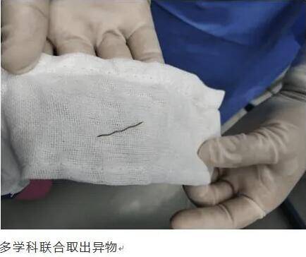 医生|男子食堂吃饭吞下2.5厘米金属针！如鲠在喉却找不到......