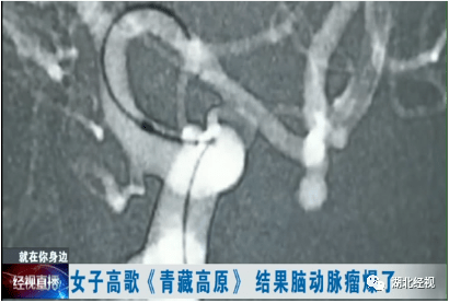 什么是动脉瘤性蛛网膜下腔出血 036a4267f3c6490c911eade92c49a261.png