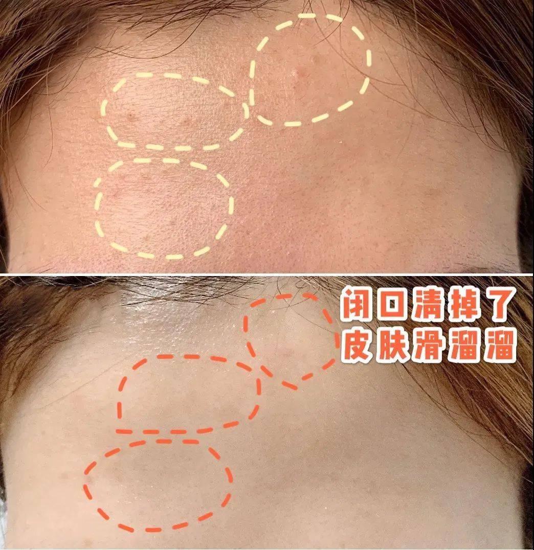 闭口@,脸上“小疙瘩”老去不掉?幸亏我没放弃这么做,原来额头可以这么光滑