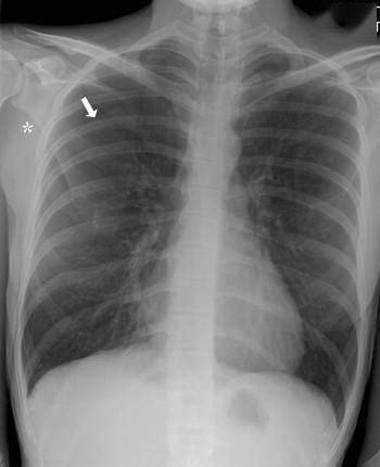 图 9a: 继发性气胸 这张后前位胸片显示了一种未自行消退的明显的