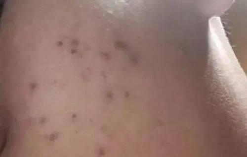 成分|晒斑和黑痘印,还能整一整吗?