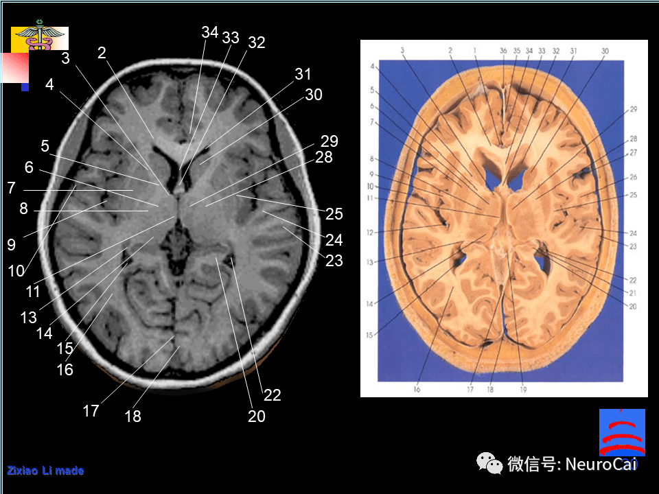 影像解剖 脑局部解剖与功能图谱