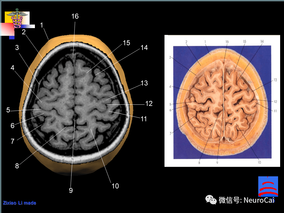 影像解剖 脑局部解剖与功能图谱_头皮