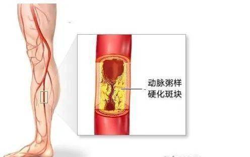 05  下肢动脉硬化闭塞症 小腿抽筋频繁,还要警惕血管性疾病可能,尤其