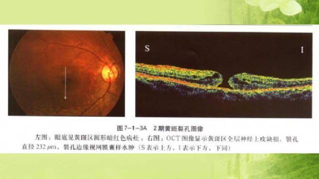 眼底病黄斑裂孔