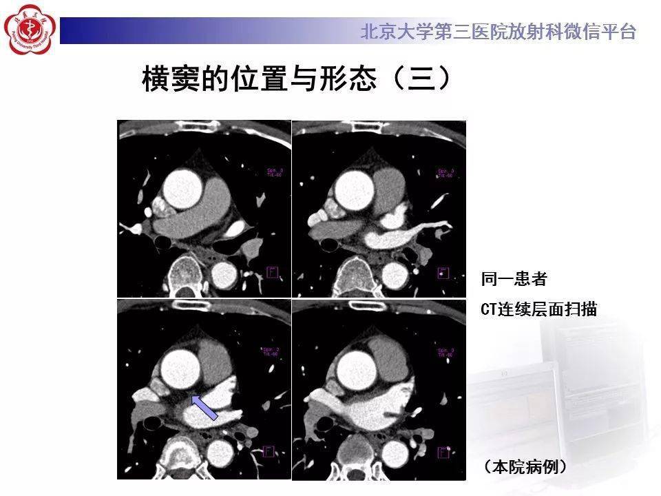 影像精美解剖丨心包窦及心包隐窝解剖,建议收藏!