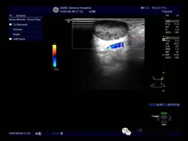 【超声随响】第03期 表皮样囊肿 epidermoid cyst