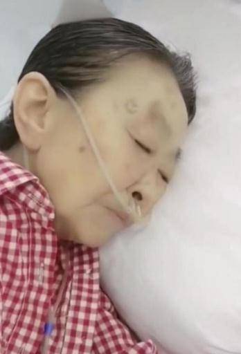 83岁“丑娘”张少华独自住院,双鼻插管面容憔悴