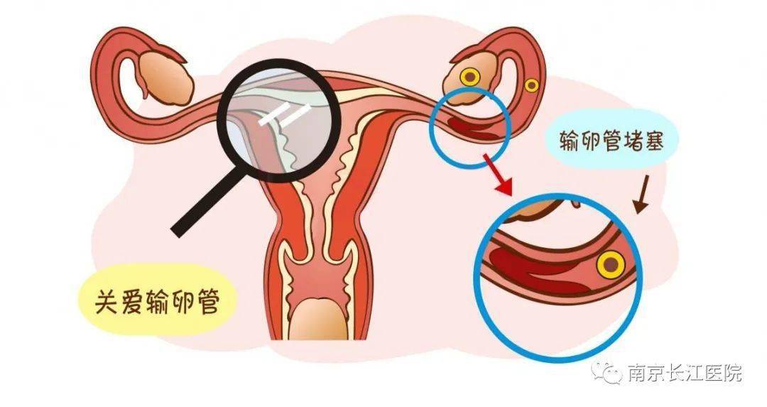 长江科普从没怀过孕输卵管为什么也会堵塞