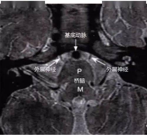 收藏外展神经的解剖影像与临床大全