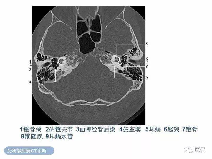 经典收藏:最全颞骨详细ct解剖