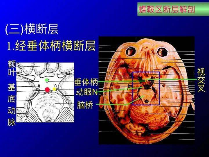 【推荐】鞍区应用解剖 断层解剖图谱