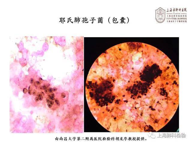 肺孢子菌病的临床特点实验室检测治疗及预防