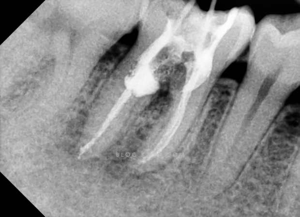髓室底穿和根管侧穿是牙体科和修复科的医师都会遇到的意外事故,是