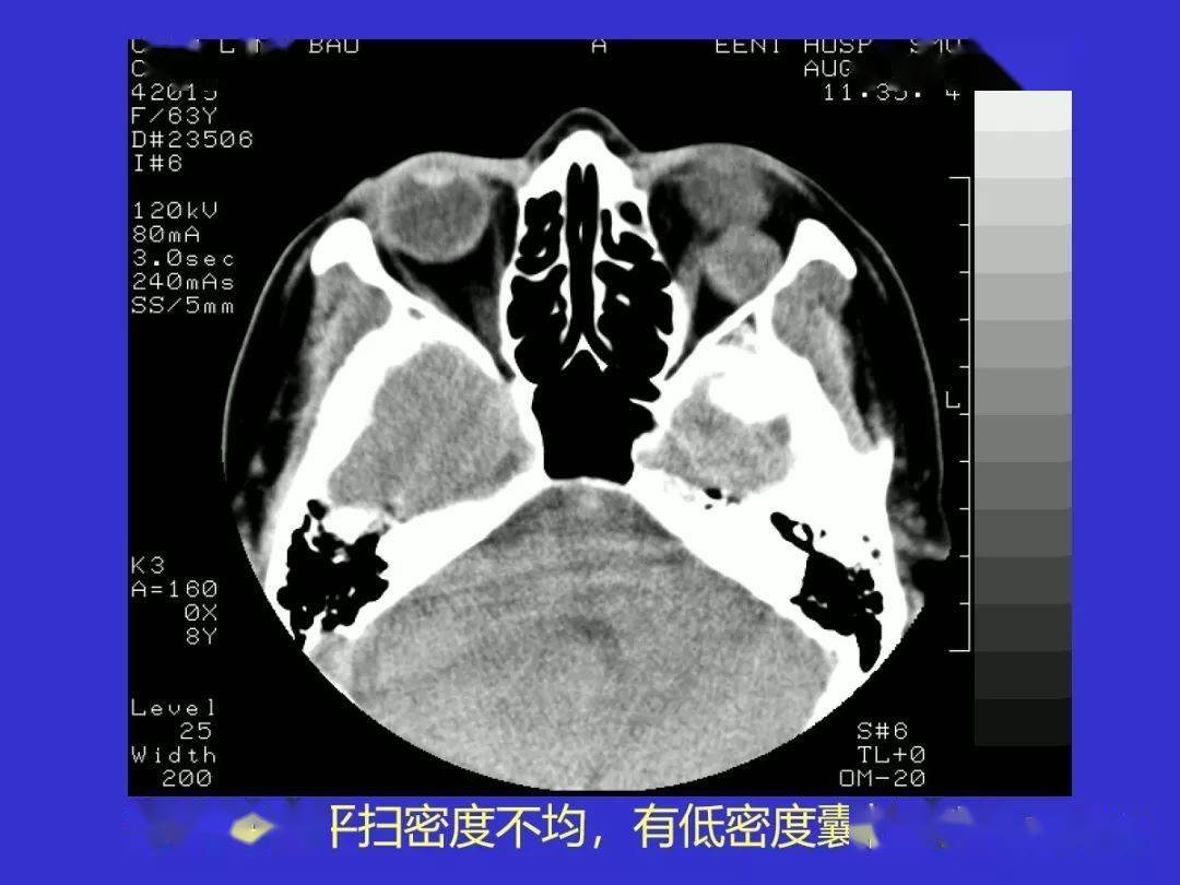 眼眶骨折常见的CT表现-搜狐大视野-搜狐新闻