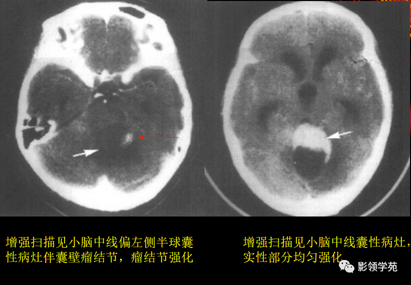 15中常见颅内肿瘤的ct表现