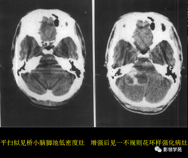 15中常见颅内肿瘤的ct表现