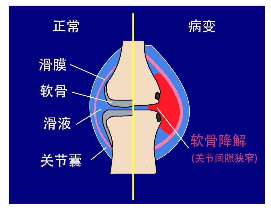 膝关节活动的时候咔咔响,这就是关节炎吗,教你在家如何评估!_情况