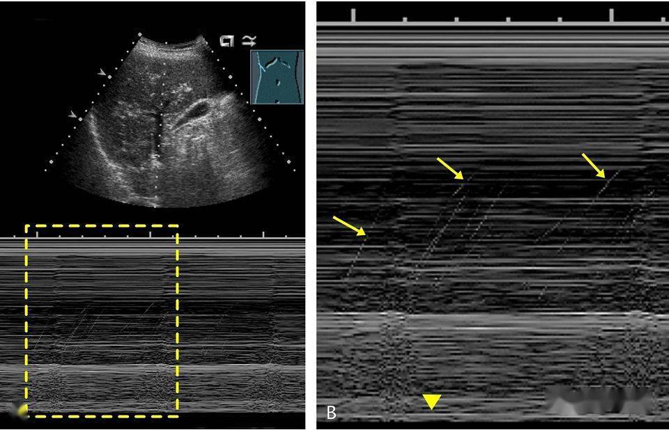 肝门静脉气体在 m 型超声上显示方向各异的斜向线样高回声,即「流星雨