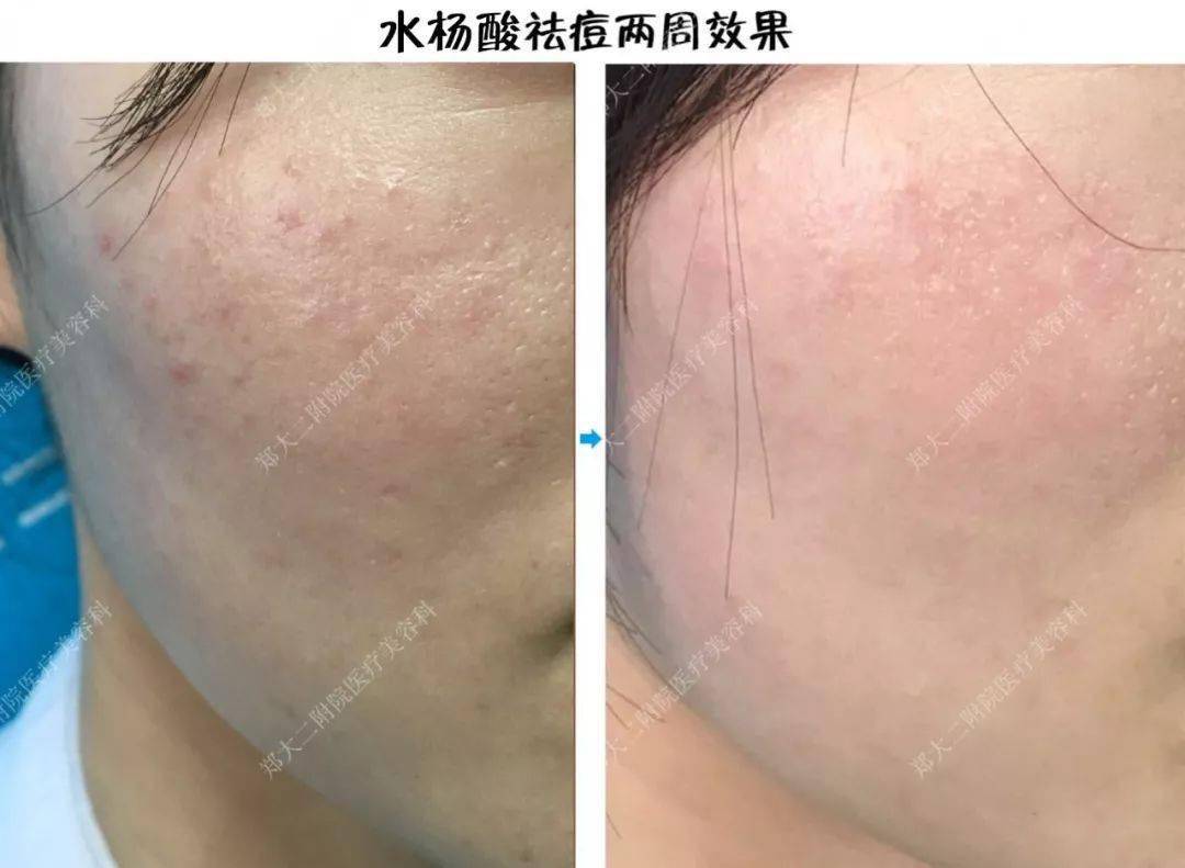 祛痘|30秒get医美“刷酸” ，从此和痘痘大毛孔形同陌路！