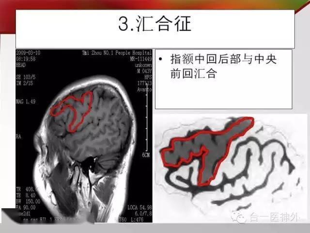 如何在ct及mri图像上辨识脑沟回