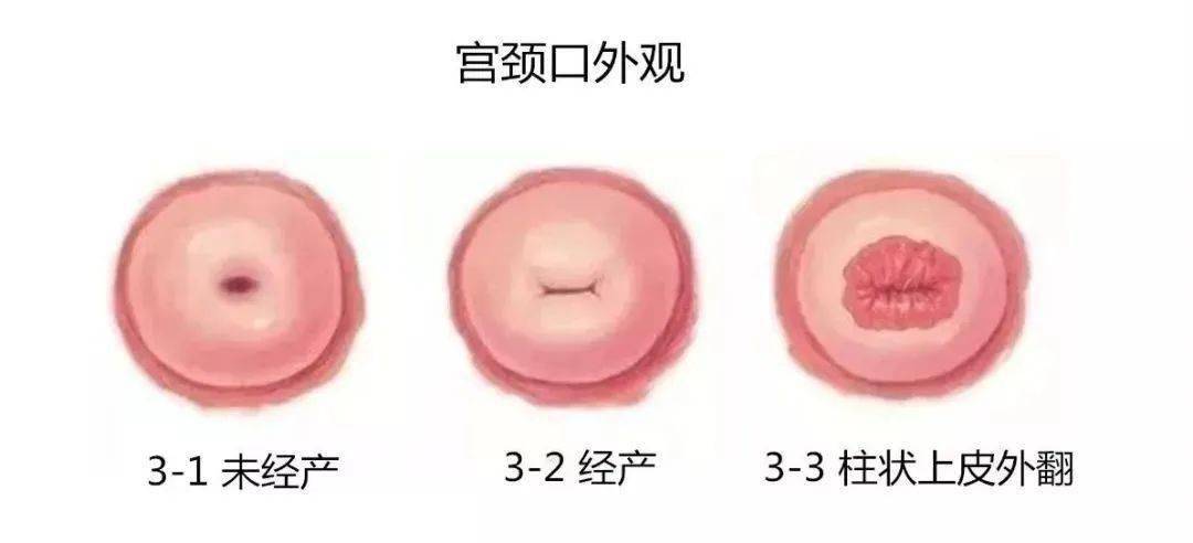 在排除宫颈癌及宫颈的炎症外,考虑为  生理性柱状上皮异位,一般是不