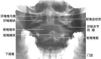 ②寰椎侧块明显,显影浓密,分居齿突两侧.其上关节凹与枕髁关节.