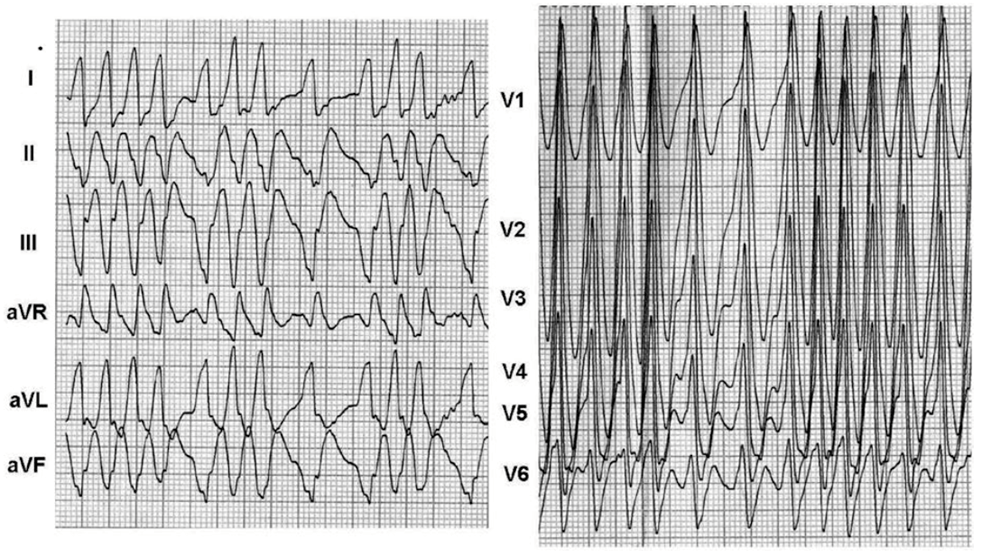 患者|这个房颤患者，让医生直呼“太惨了”……